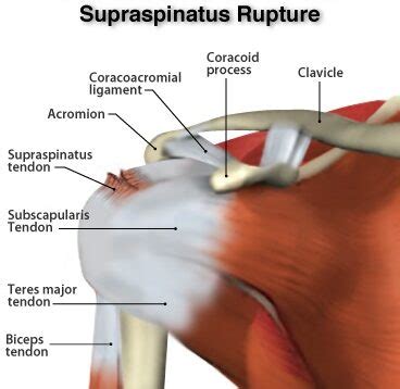 test for tear of supraspinatus|complete rupture of supraspinatus tendon.